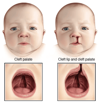 cleft lip and palate