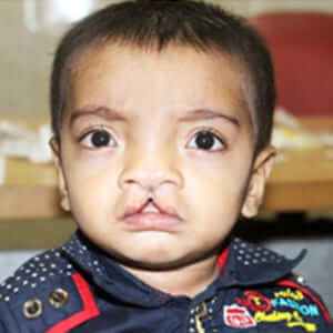 midline cleft patient