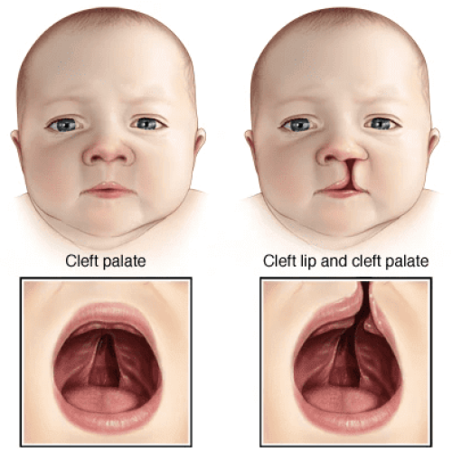 cleft lip and palate